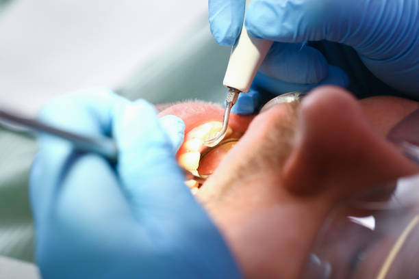 Best Emergency Root Canal Therapy in Belmont, WI